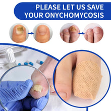 Waterproof Toenail Correction and Repair Patches